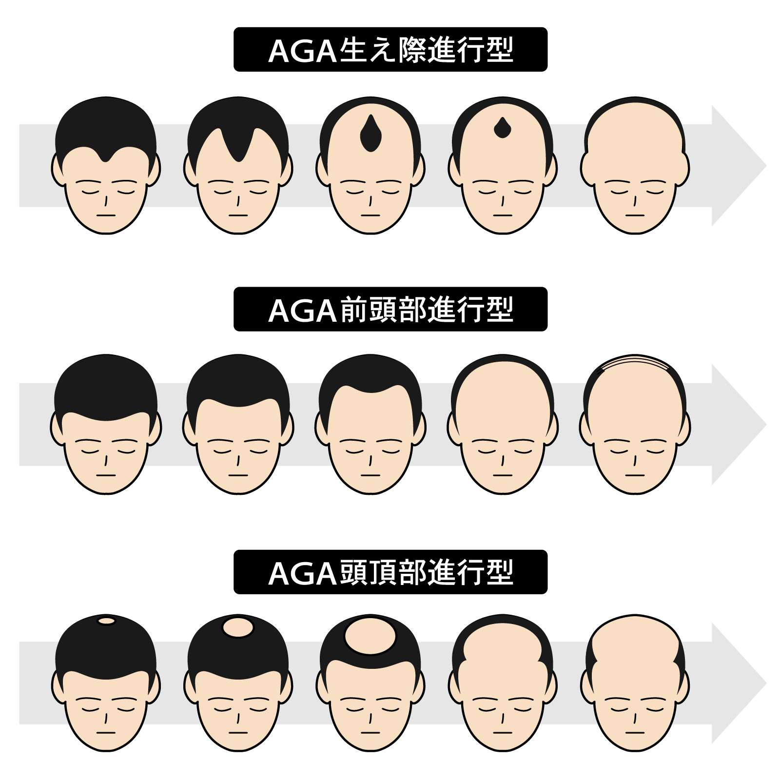 AGA（男性型脱毛症）は治療できる病気です